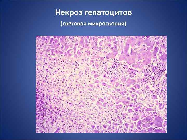 Некроз гепатоцитов (световая микроскопия) 