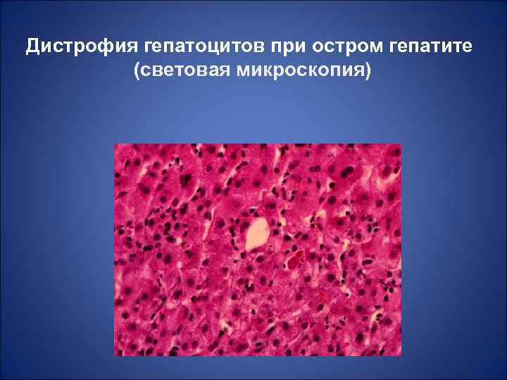 Дистрофия гепатоцитов при остром гепатите (световая микроскопия) 