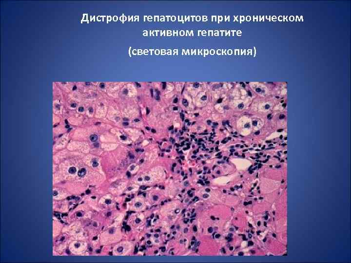 Дистрофия гепатоцитов при хроническом активном гепатите (световая микроскопия) 