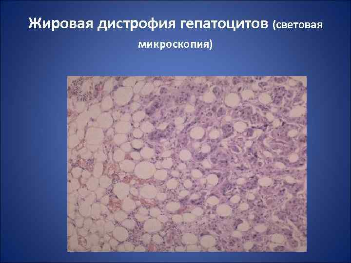 Жировая дистрофия гепатоцитов (световая микроскопия) 