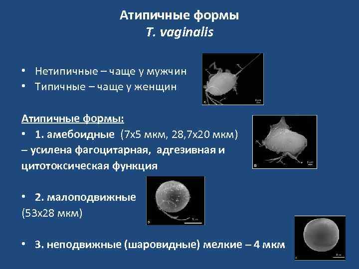 Атипичные формы T. vaginalis • Нетипичные – чаще у мужчин • Типичные – чаще