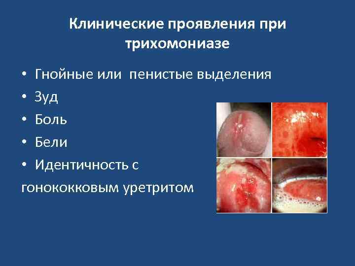 Клинические проявления при трихомониазе • Гнойные или пенистые выделения • Зуд • Боль •