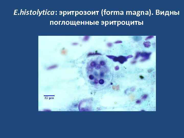 E. histolytica: эритрозоит (forma magna). Видны поглощенные эритроциты 