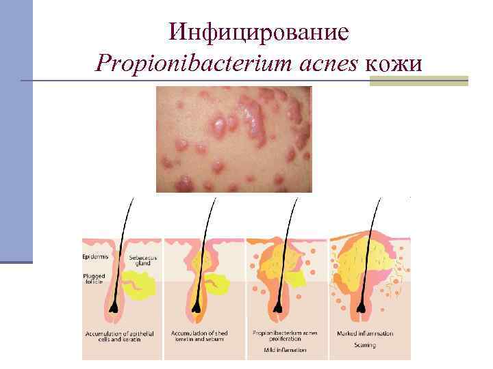 Инфицирование Propionibacterium acnes кожи 