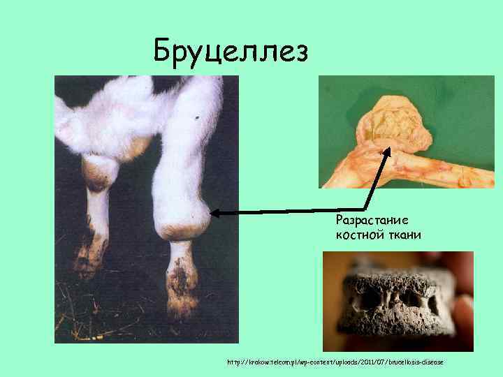 Бруцеллез Разрастание костной ткани http: //krakow. telcom. pl/wp-content/uploads/2011/07/brucellosis-disease 