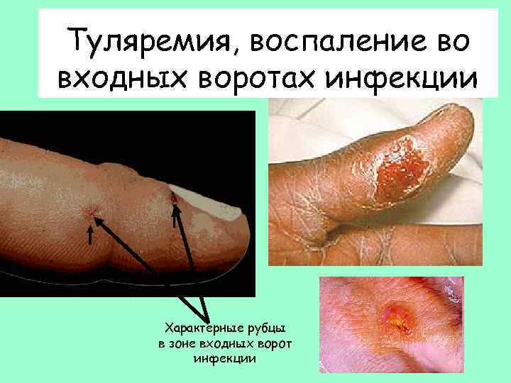 Туляремия, воспаление во входных воротах инфекции Характерные рубцы в зоне входных ворот инфекции 