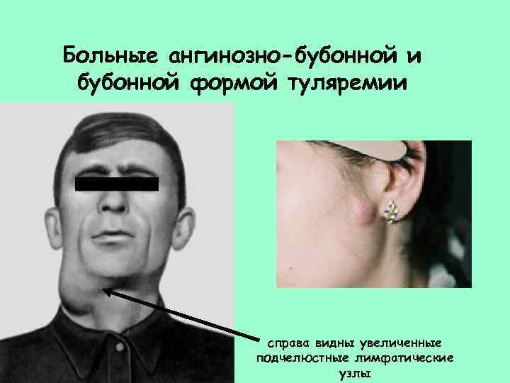 Больные ангинозно-бубонной и бубонной формой туляремии справа видны увеличенные подчелюстные лимфатические узлы 