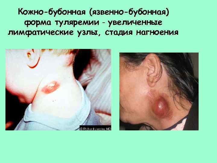 Кожно-бубонная (язвенно-бубонная) форма туляремии - увеличенные лимфатические узлы, стадия нагноения 