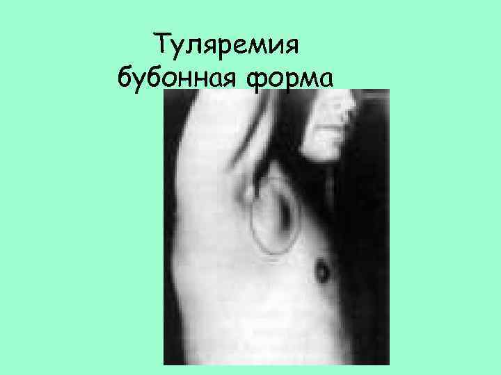 Туляремия бубонная форма 