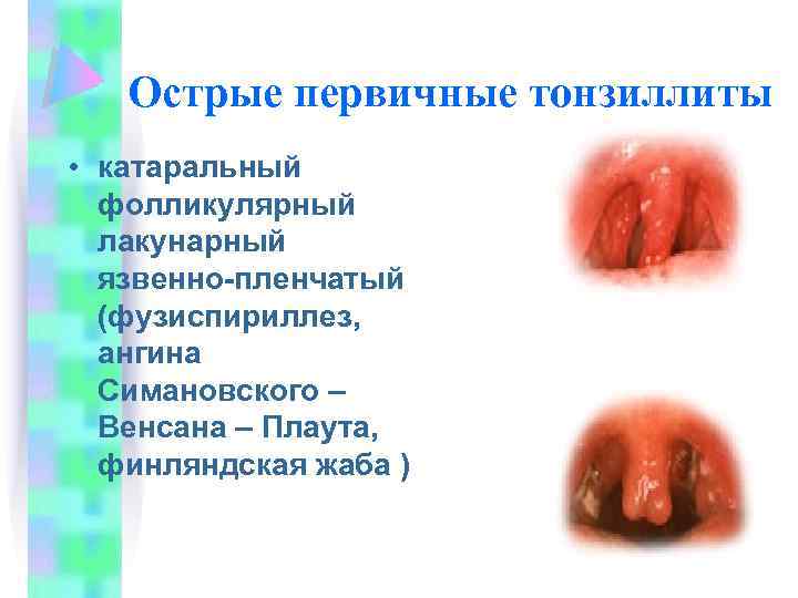 Острые первичные тонзиллиты • катаральный фолликулярный лакунарный язвенно-пленчатый (фузиспириллез, ангина Симановского – Венсана –