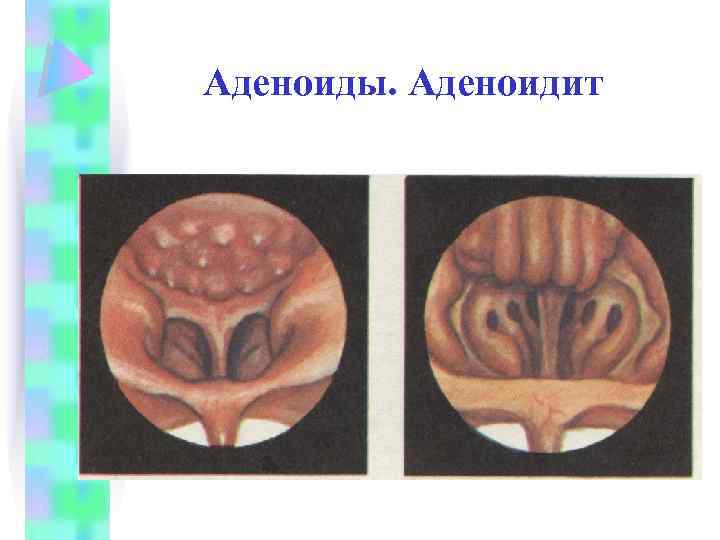 Аденоиды. Аденоидит 