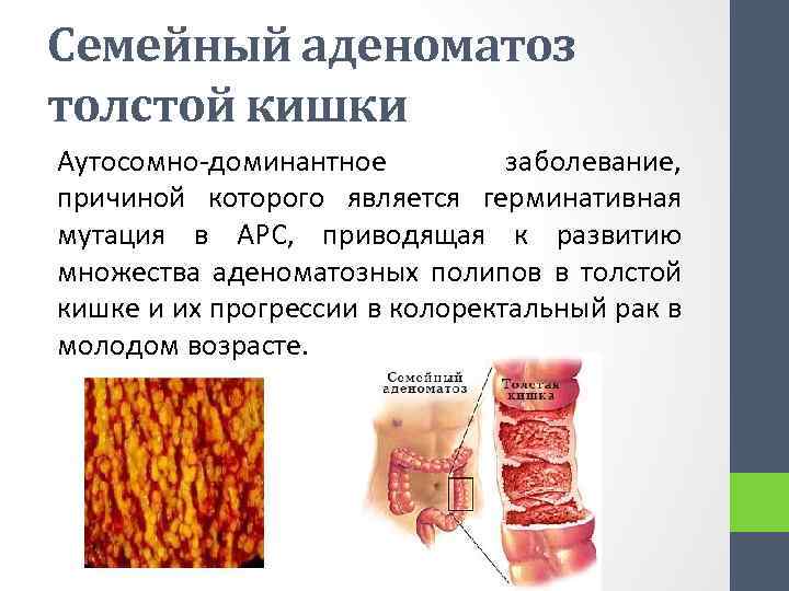 Семейный аденоматоз толстой кишки Аутосомно-доминантное заболевание, причиной которого является герминативная мутация в APC, приводящая