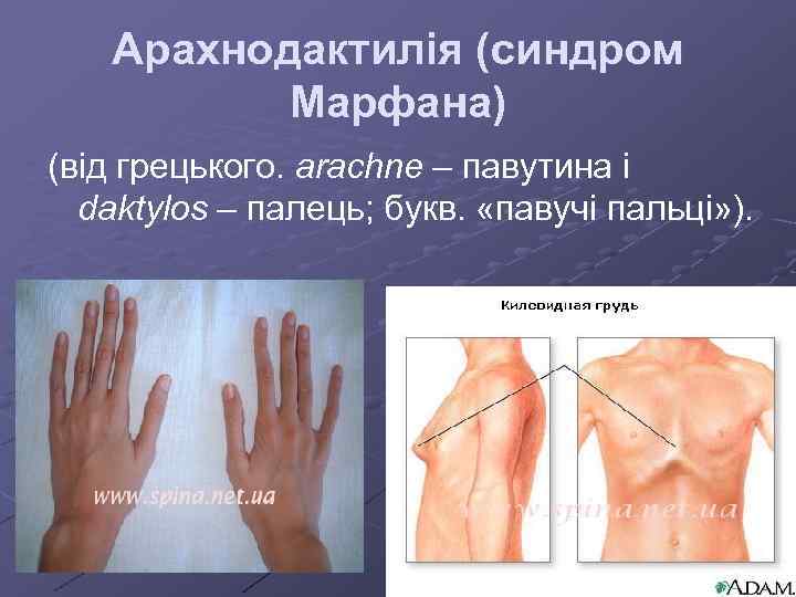 Арахнодактилія (синдром Марфана) (від грецького. arachne – павутина і daktylos – палець; букв. «павучі