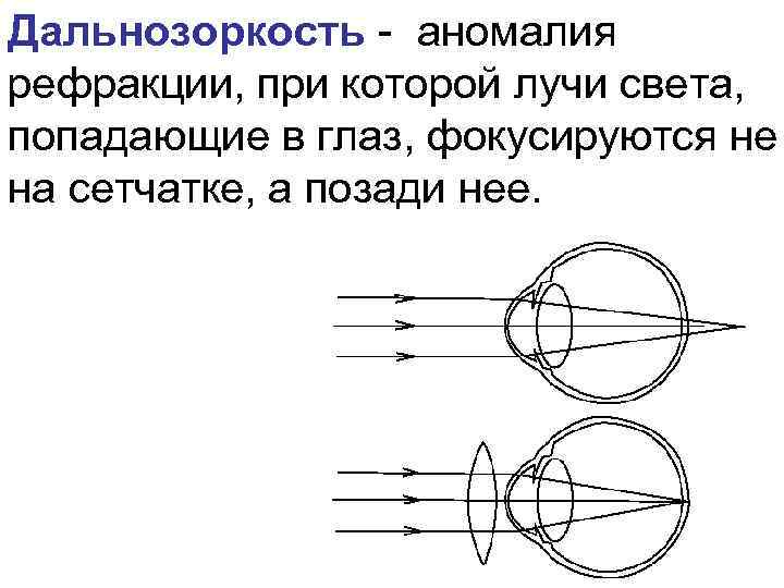 Аномалии рефракции глаза близорукость дальнозоркость. Схемы рефракции при нормальном зрении при миопии при гиперметропии. Аномалии рефракции глаза их коррекция. Лучи света фокусируются за сетчаткой