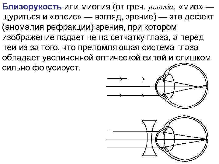 Близорукость или миопия (от греч. μυωπία, «мио» — щуриться и «опсис» — взгляд, зрение)