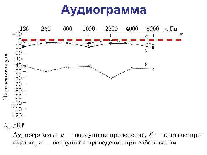 Аудиограмма в норме рисунок