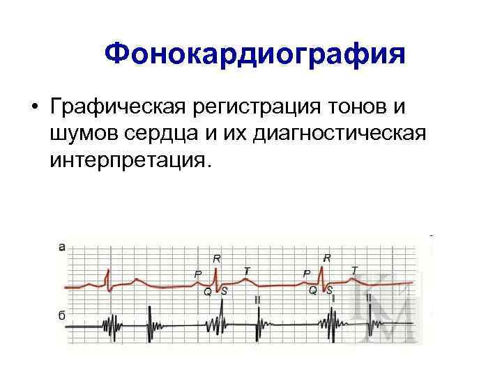 Фонокардиография • Графическая регистрация тонов и шумов сердца и их диагностическая интерпретация. 