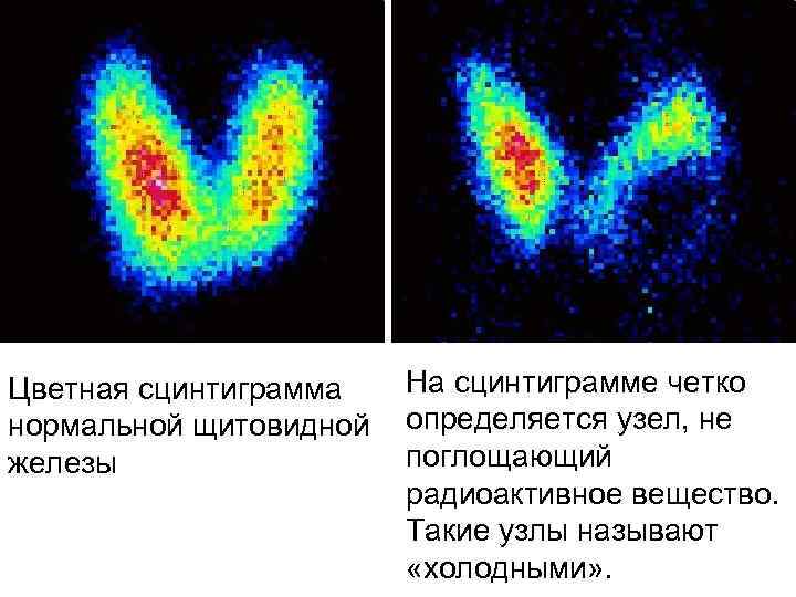 Сцинтиграфия щитовидной железы картинки