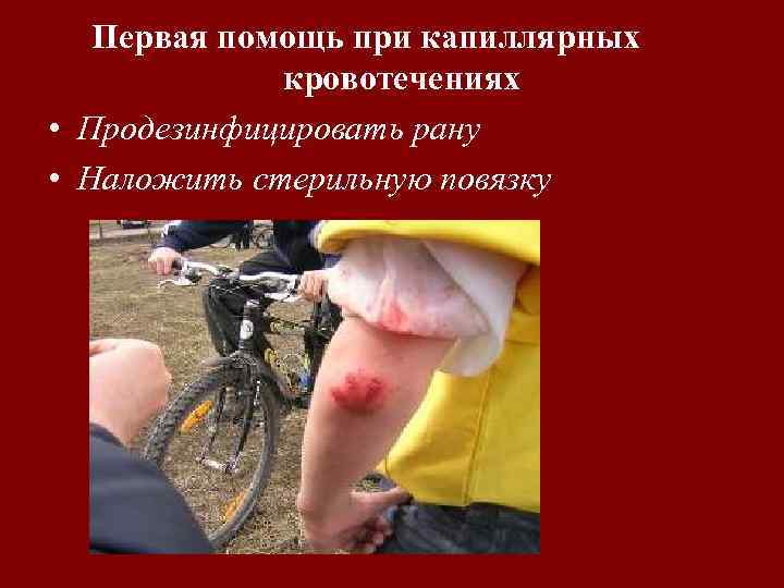 Первая помощь при капиллярных кровотечениях • Продезинфицировать рану • Наложить стерильную повязку 