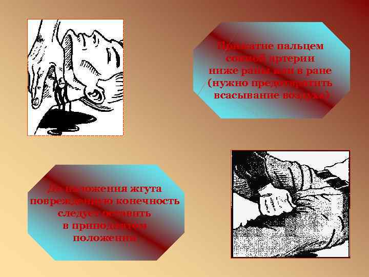 Прижатие пальцем сонной артерии ниже раны или в ране (нужно предотвратить всасывание воздуха) До