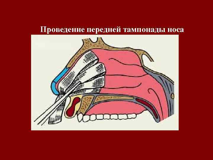 Проведение передней тампонады носа 