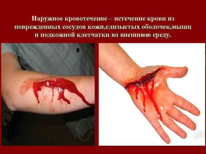 Наружное кровотечение – истечение крови из поврежденных сосудов кожи, слизыстых оболочек, мышц и подкожной