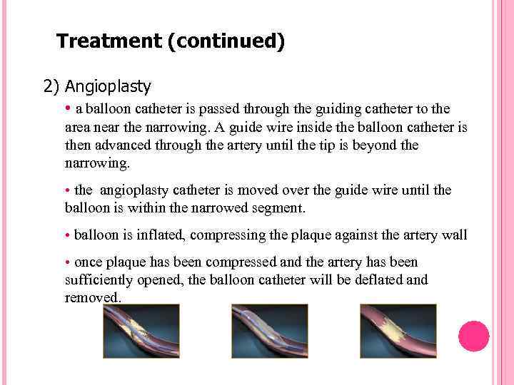 Treatment (continued) 2) Angioplasty • a balloon catheter is passed through the guiding catheter