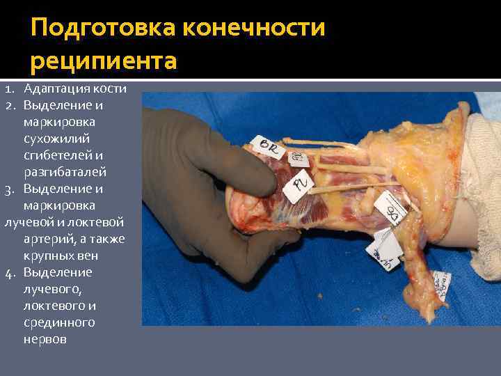 Подготовка конечности реципиента 1. Адаптация кости 2. Выделение и маркировка сухожилий сгибетелей и разгибаталей