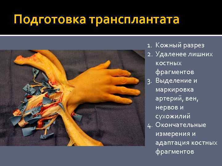 Подготовка трансплантата 1. Кожный разрез 2. Удаленее лишних костных фрагментов 3. Выделение и маркировка
