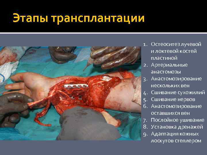 Этапы трансплантации 1. Остеоситез лучевой и локтевой костей пластиной 2. Артериальные анастомозы 3. Анастомозирование