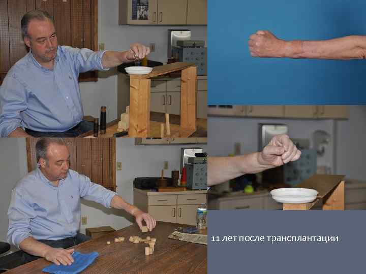 11 лет после трансплантации 