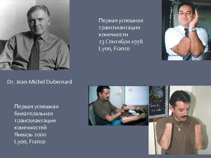 Первая успешная трансплантация конечности 23 Сентября 1998 Lyon, France Dr. Jean-Michel Dubernard Первая успешная