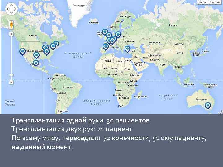 Трансплантация одной руки: 30 пациентов Трансплантация двух рук: 21 пациент По всему миру, пересадили