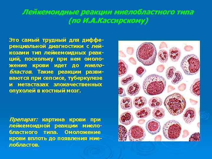 Лейкемоидные реакции миелобластного типа (по И. А. Кассирскому) Это самый трудный для дифференциальной диагностики