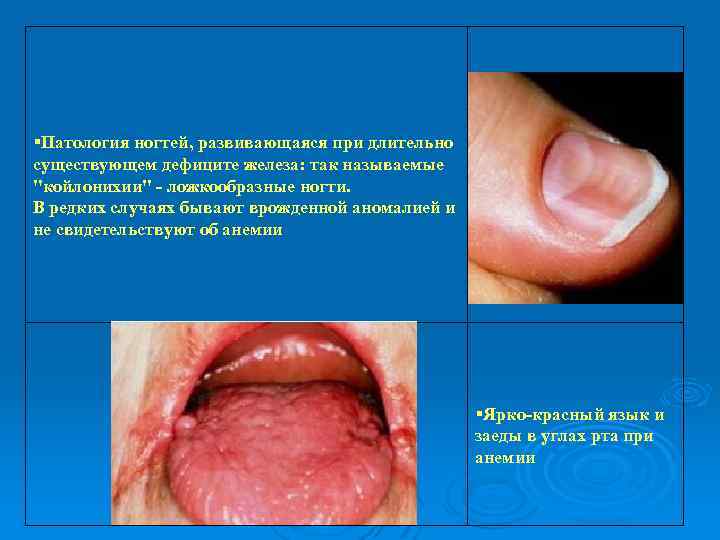  Патология ногтей, развивающаяся при длительно существующем дефиците железа: так называемые 
