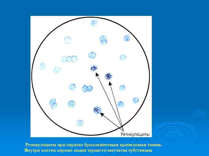  Ретикулоциты при окраске бриллиантовым кризиловым синим. Внутри клеток хорошо видна зернисто-нитчатая субстанция 