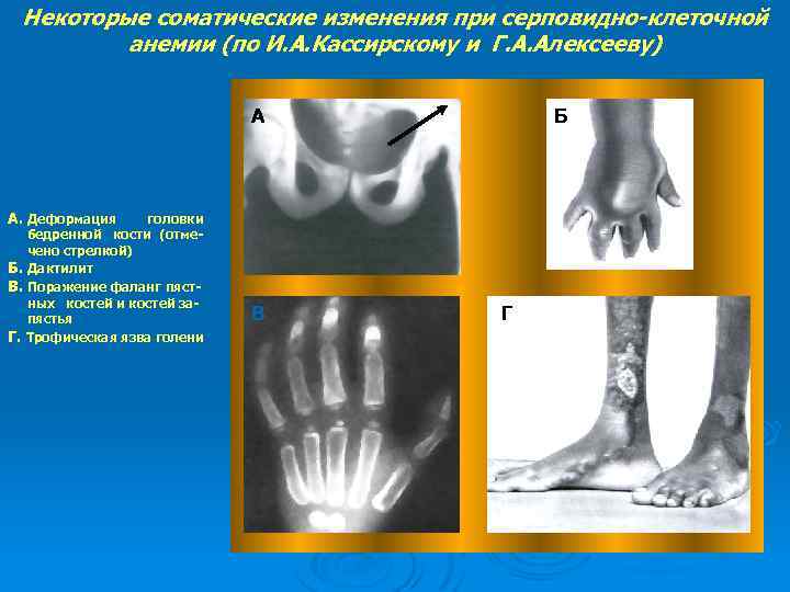 Некоторые соматические изменения при серповидно-клеточной анемии (по И. А. Кассирскому и Г. А. Алексееву)