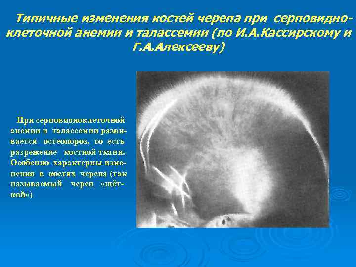Типичные изменения костей черепа при серповидноклеточной анемии и талассемии (по И. А. Кассирскому и