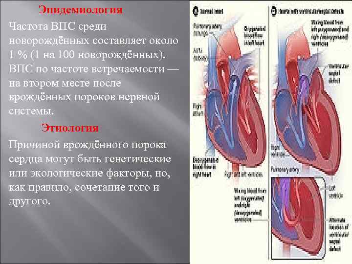 Пороки сердца названия. Врожденный порок сердца (ВПС). Частота встречаемости пороков сердца. ВРАЖДЕНЫЙ порог сердца. Рожденный порог сердца.