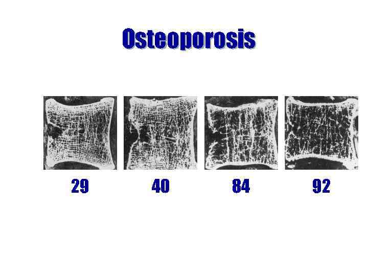 Osteoporosis 29 40 84 92 