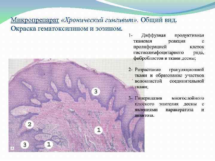 Микропрепарат «Хронический гингивит» . Общий вид. Окраска гематоксилином и эозином. 