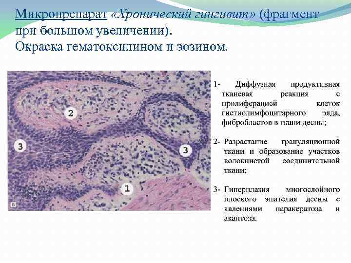 Микропрепарат «Хронический гингивит» (фрагмент при большом увеличении). Окраска гематоксилином и эозином. 