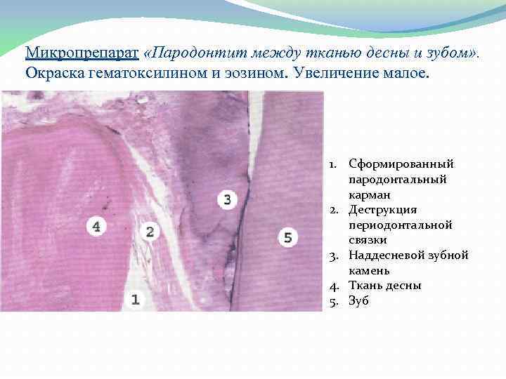 Микропрепарат «Пародонтит между тканью десны и зубом» . Окраска гематоксилином и эозином. Увеличение малое.