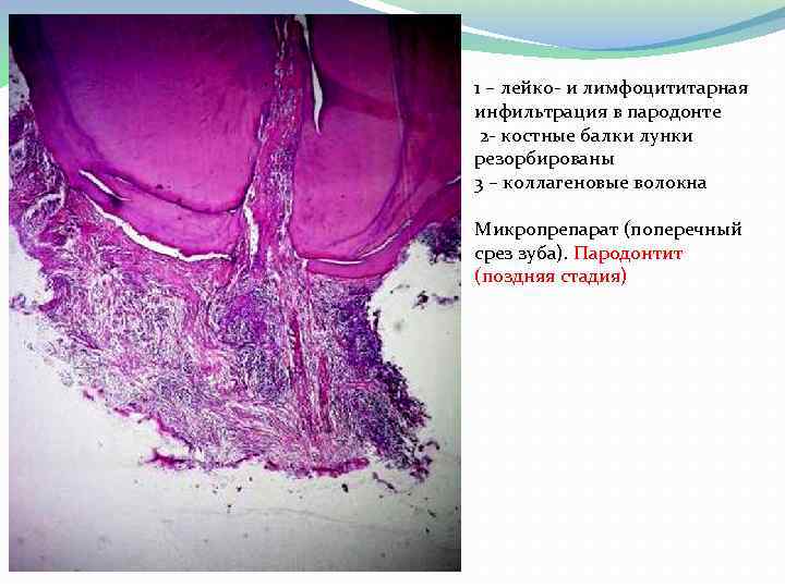  1 – лейко и лимфоцититарная инфильтрация в пародонте 2 костные балки лунки резорбированы