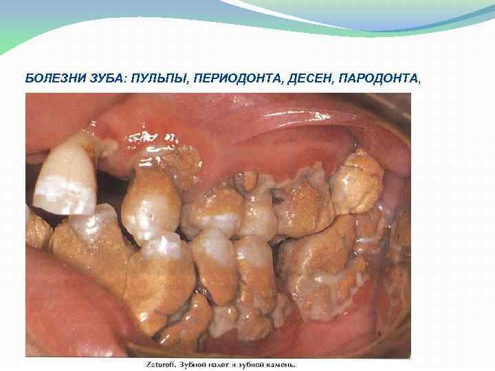 БОЛЕЗHИ ЗУБА: ПУЛЬПЫ, ПЕРИОДОНТА, ДЕСЕH, ПАРОДОHТА, 