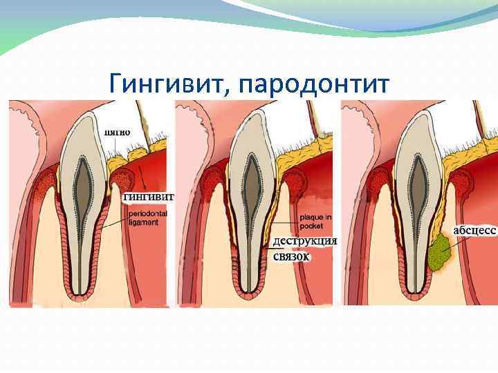 Гингивит, пародонтит 