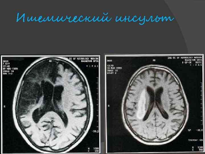 Ишемический инсульт 