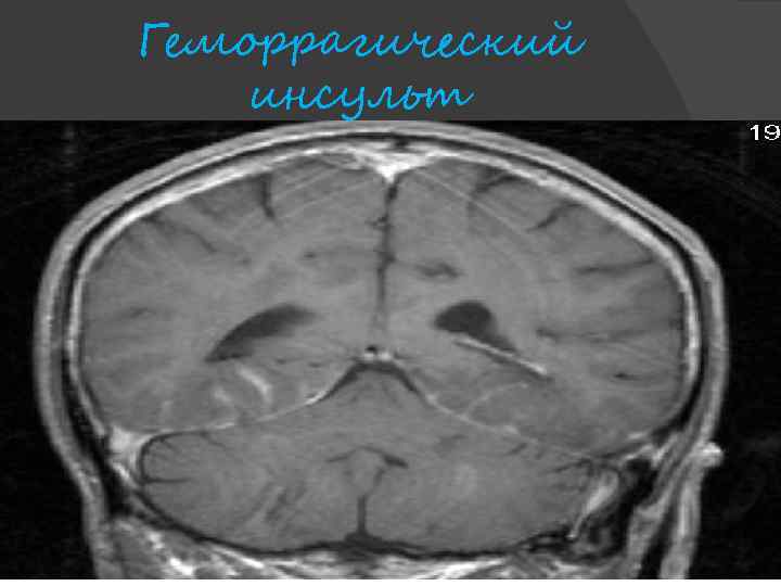Геморрагический инсульт 