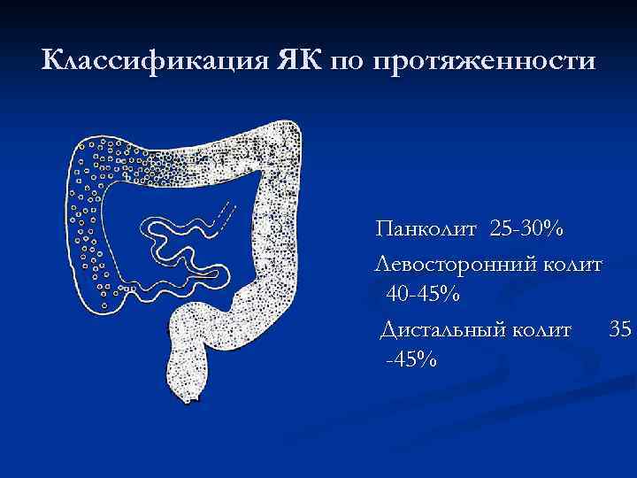 Классификация ЯК по протяженности Панколит 25 -30% Левосторонний колит 40 -45% Дистальный колит 35