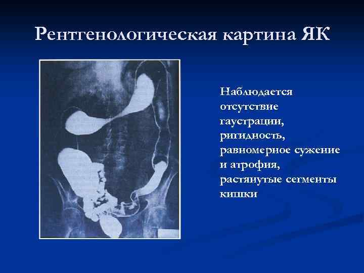 Рентгенологическая картина ЯК Наблюдается отсутствие гаустрации, ригидность, равномерное сужение и атрофия, растянутые сегменты кишки